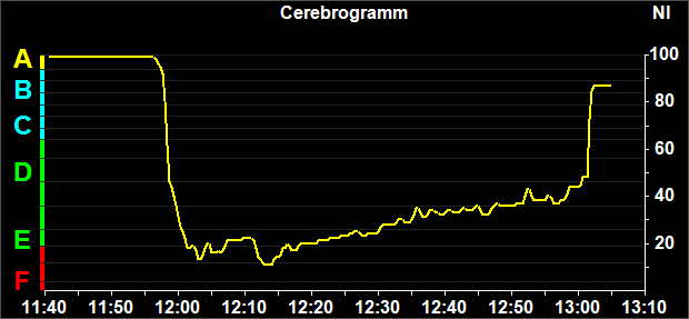Produkte - Narcotrend - EEG-Monitor für Narkose und Sedierung